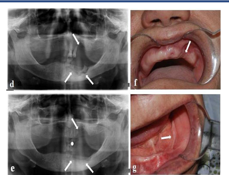 Bisphosphonate-related osteonecrosis of the jaws: Report of two cases with breast cancer, a dental concern and review of the literature